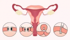 子宫内膜异位症做试管婴儿的成功率很低吗？专家：试管婴儿前的治疗